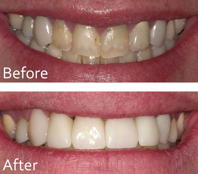 before and after a dental procedure from Chase Judd DDS large view 1