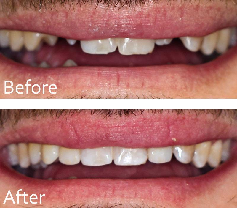 before and after a dental procedure from Chase Judd DDS large view 2