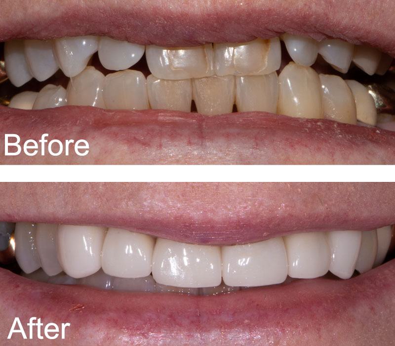 before and after a dental procedure from Chase Judd DDS large view 3Galle