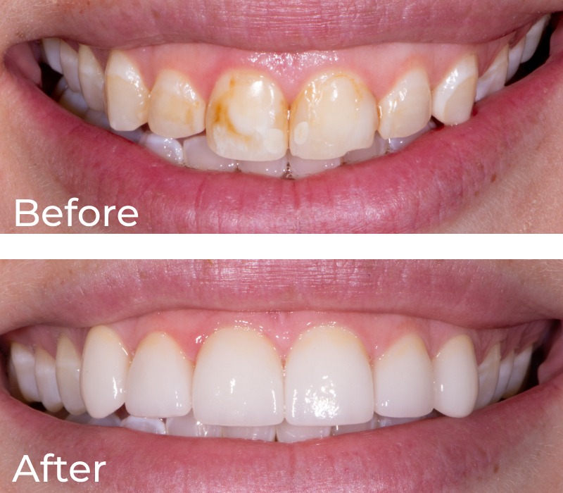 before and after a dental procedure from Chase Judd DDS large view 1